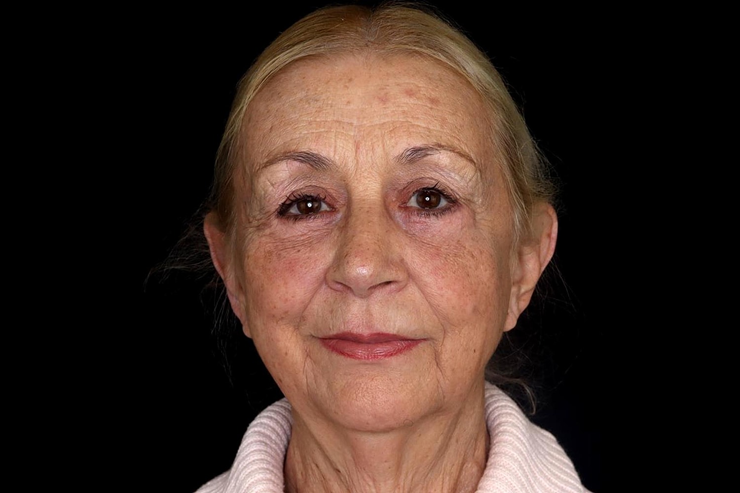 Blepharoplasty | Eyelid Lift Before & After