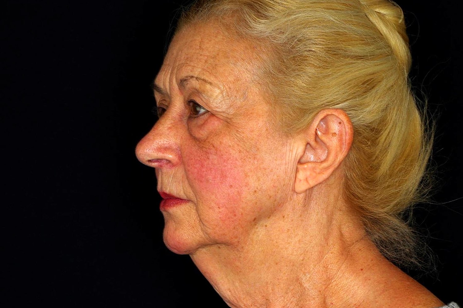 Blepharoplasty | Eyelid Lift Before & After