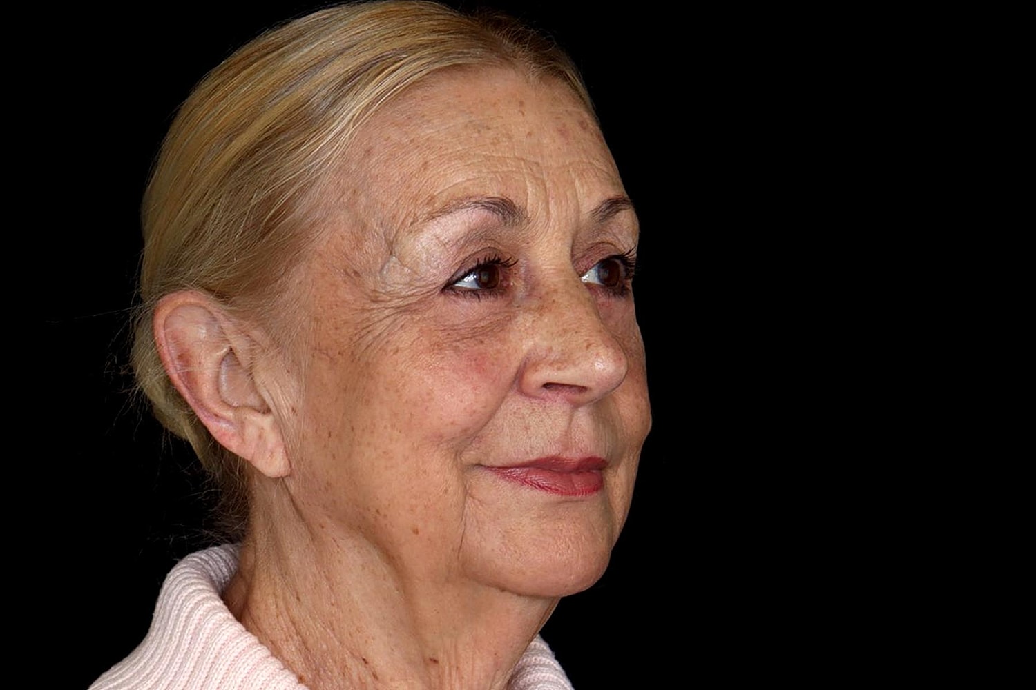 Blepharoplasty | Eyelid Lift Before & After