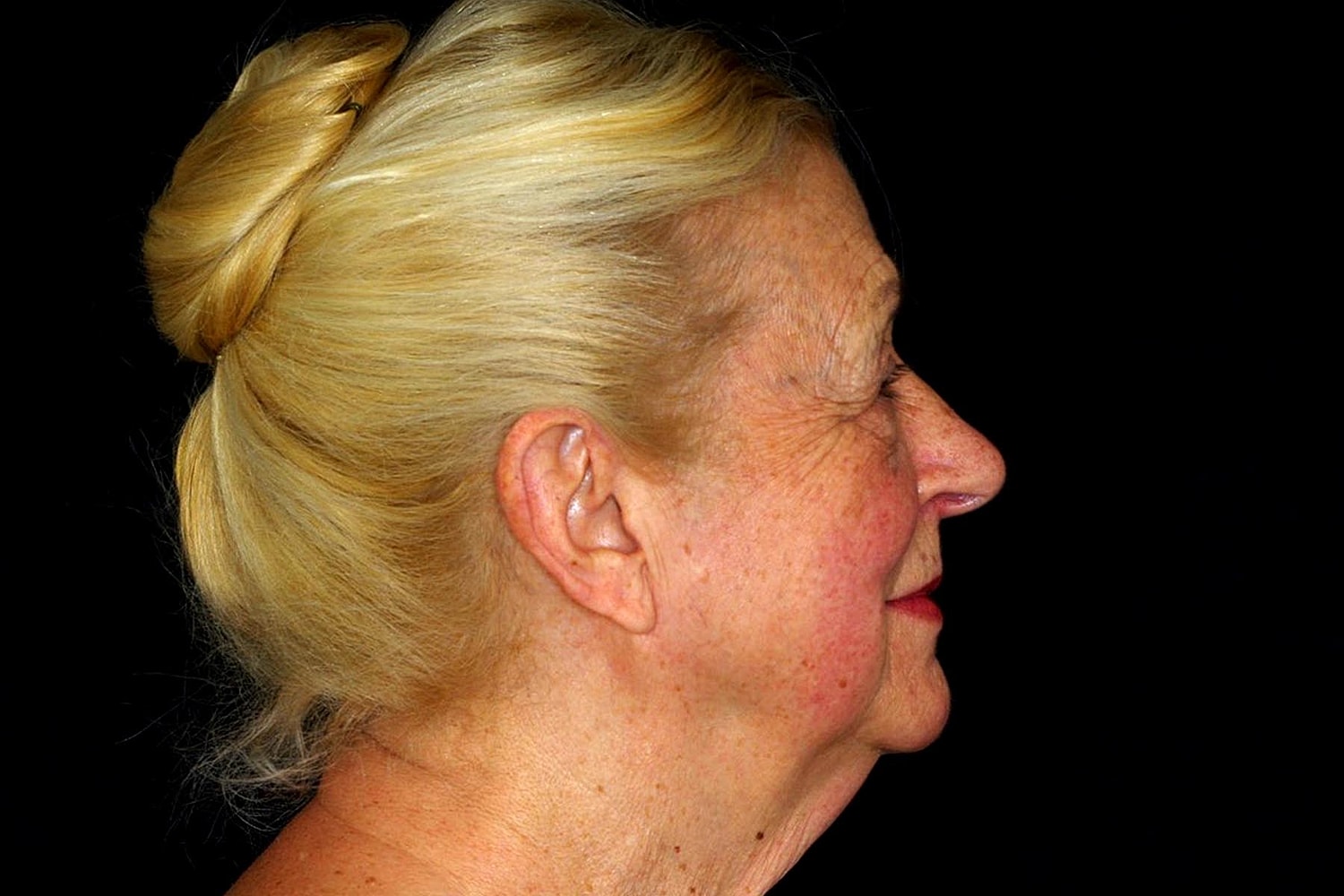 Blepharoplasty | Eyelid Lift Before & After