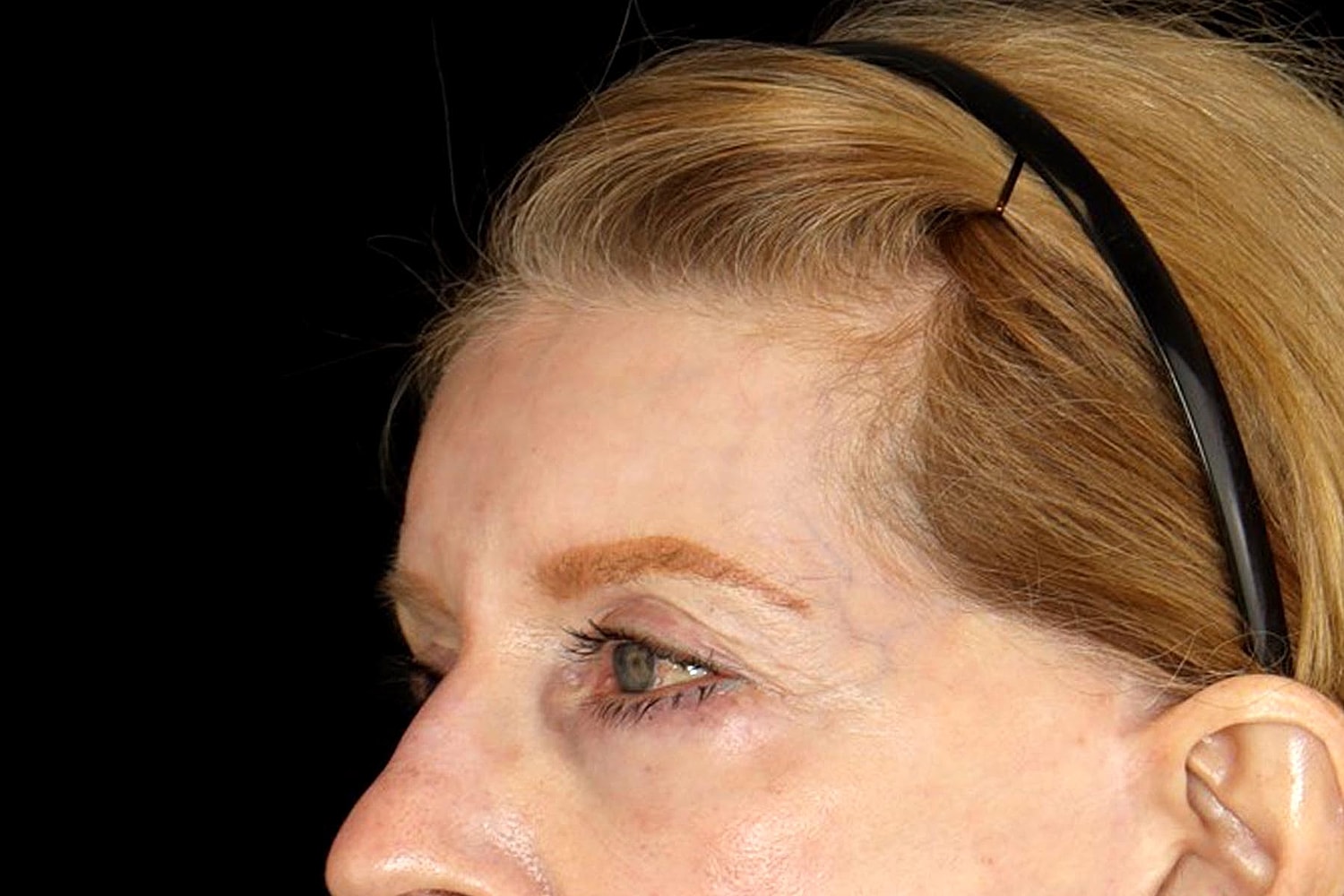 Blepharoplasty | Eyelid Lift Before & After