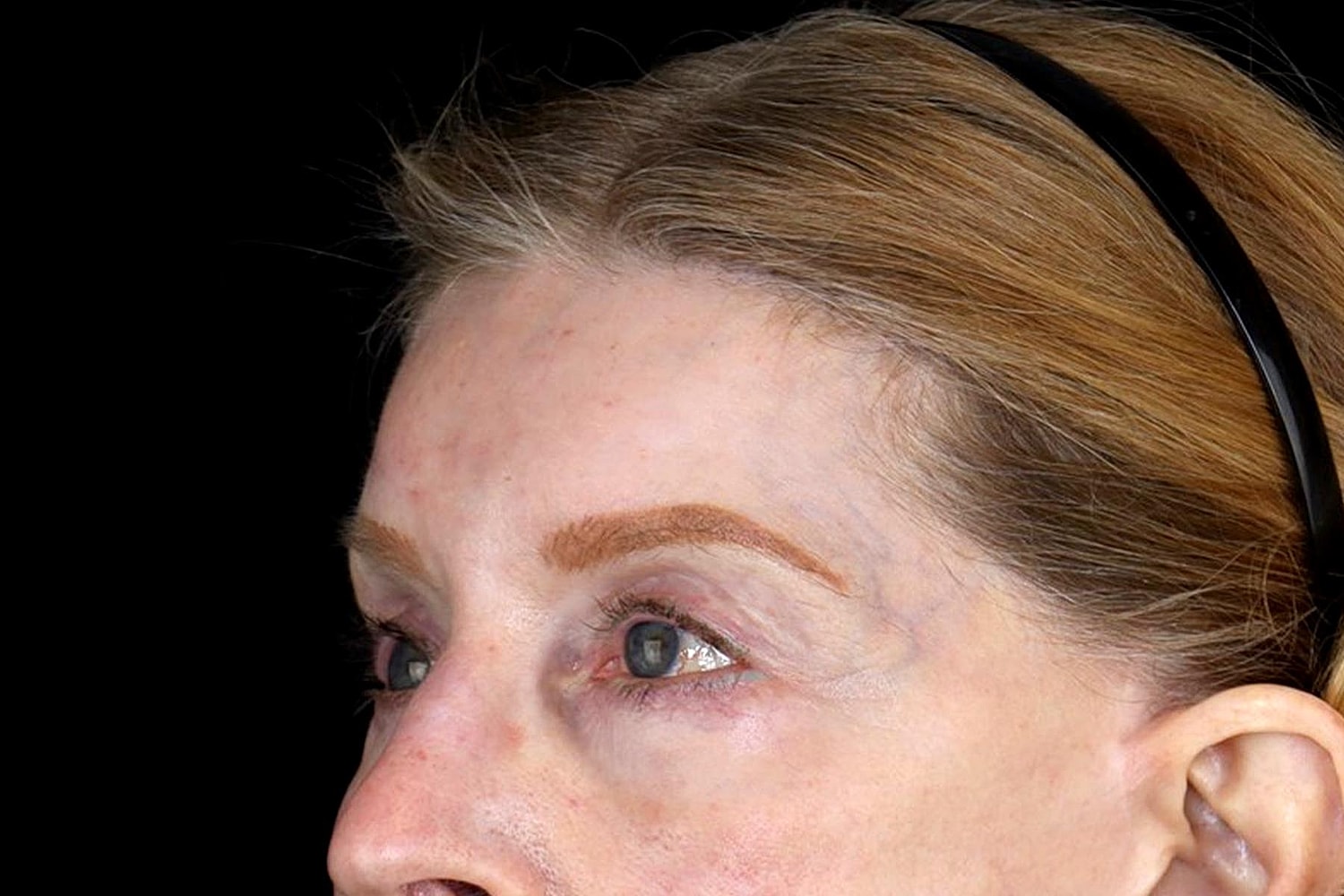 Blepharoplasty | Eyelid Lift Before & After