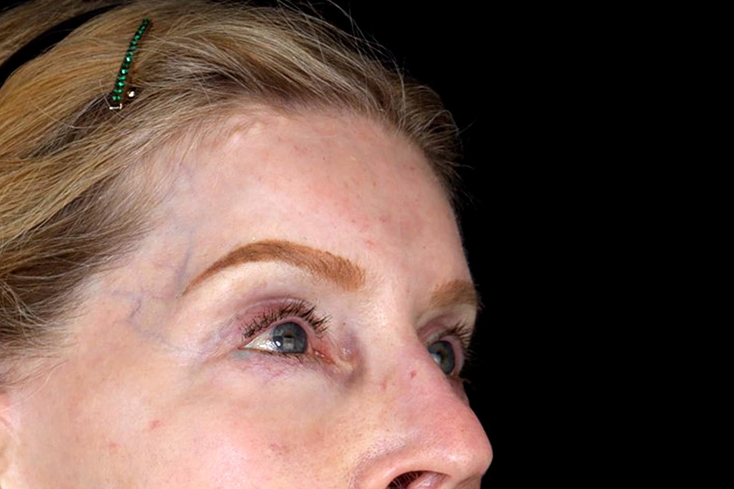 Blepharoplasty | Eyelid Lift Before & After