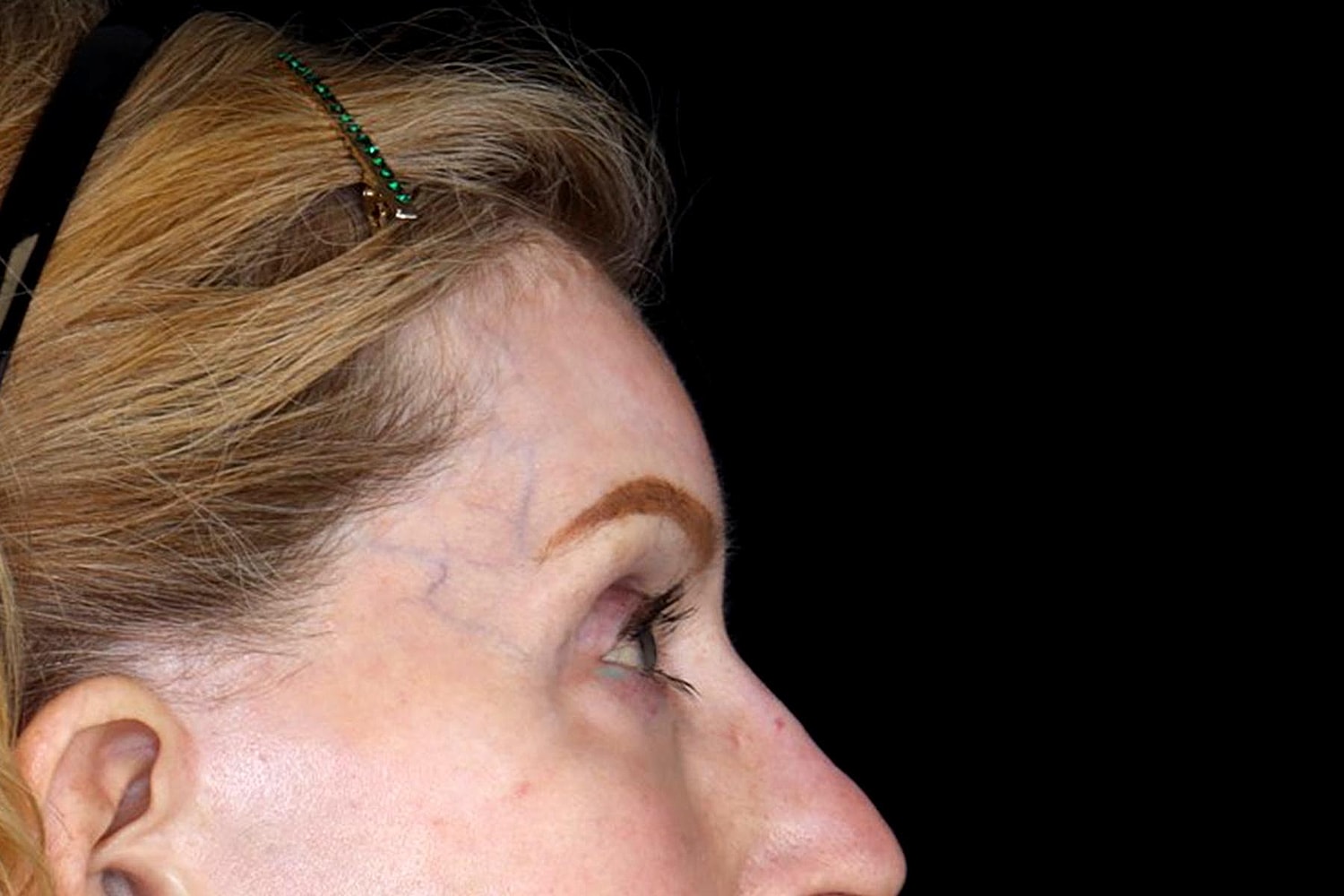 Blepharoplasty | Eyelid Lift Before & After