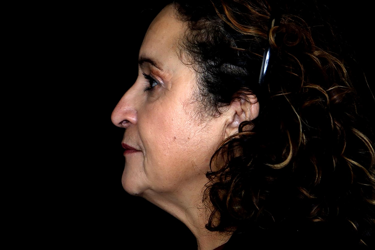Blepharoplasty | Eyelid Lift Before & After
