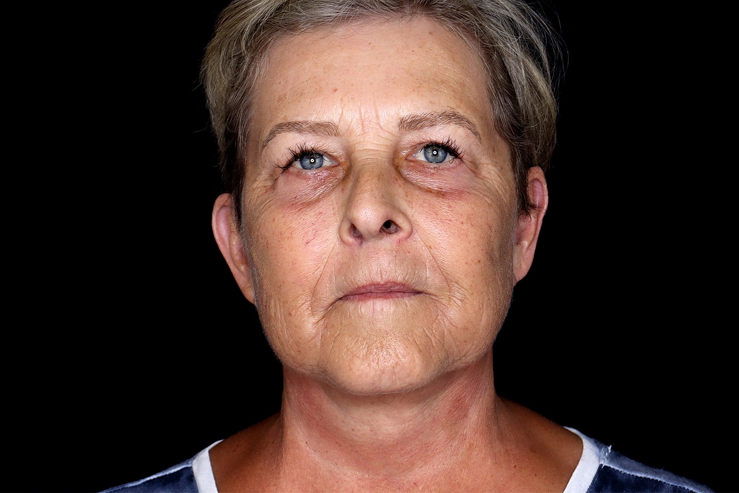 Blepharoplasty | Eyelid Lift Before & After
