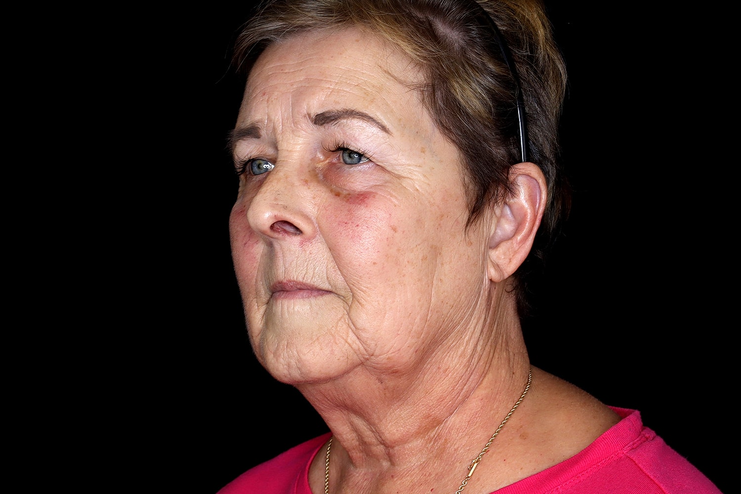 Blepharoplasty | Eyelid Lift Before & After