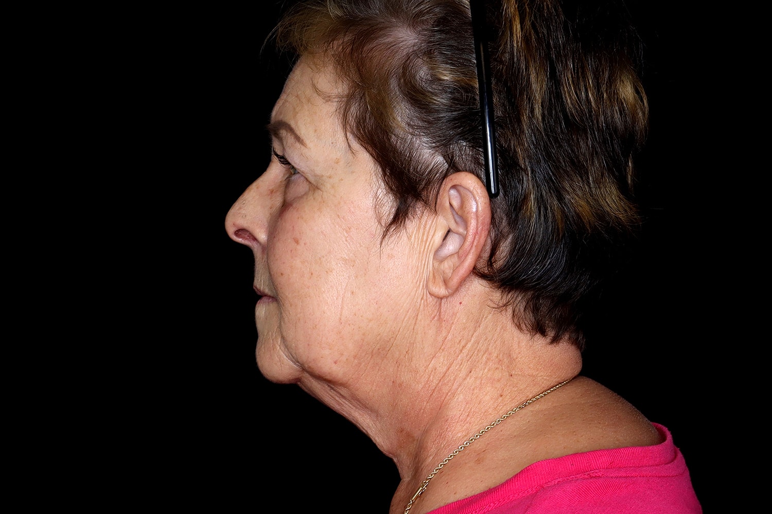 Blepharoplasty | Eyelid Lift Before & After