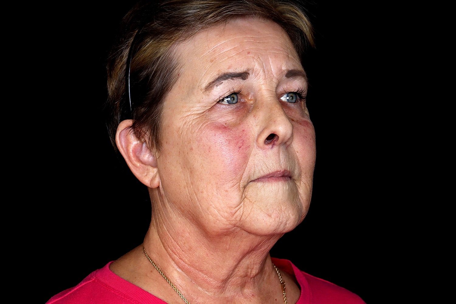 Blepharoplasty | Eyelid Lift Before & After