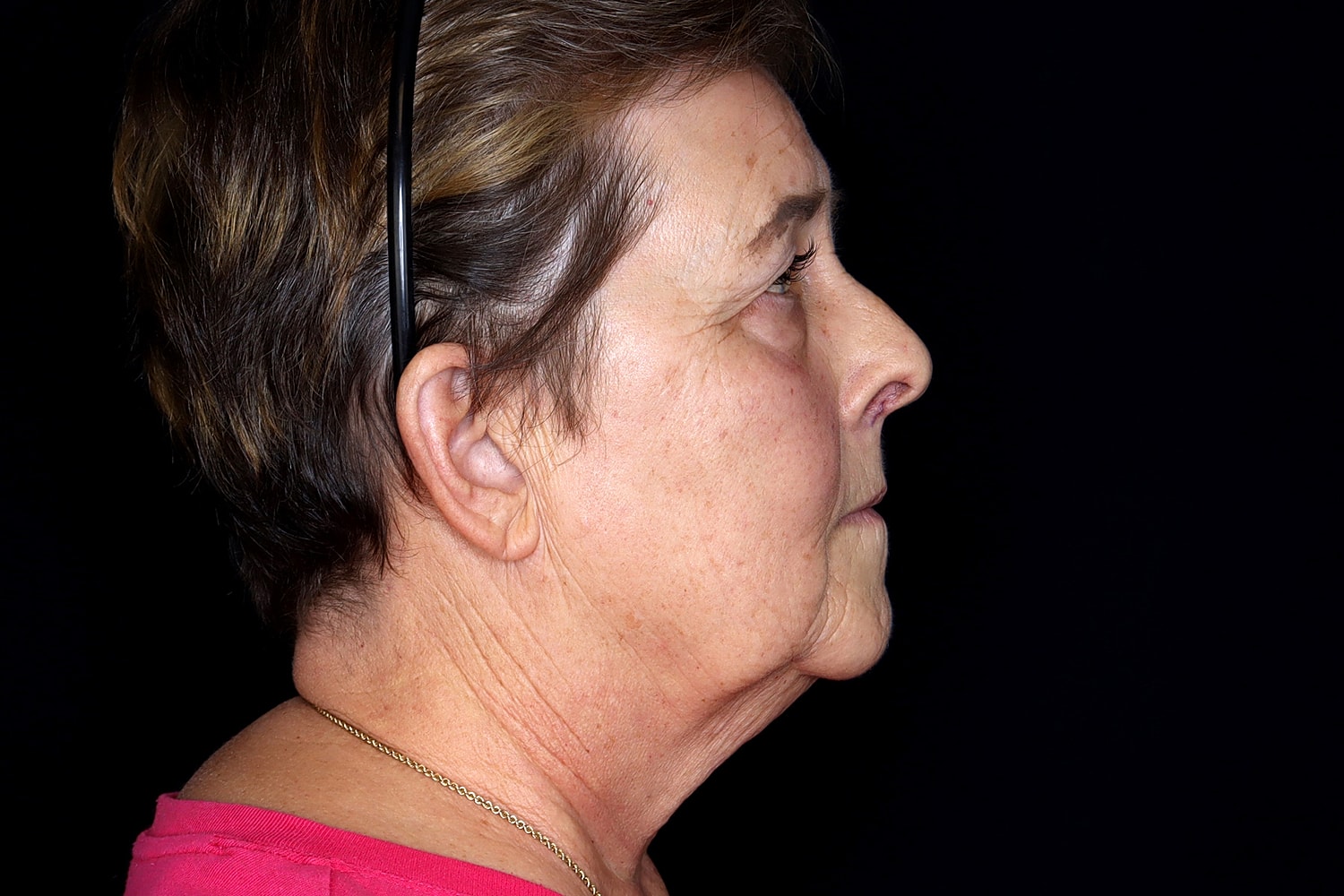 Blepharoplasty | Eyelid Lift Before & After
