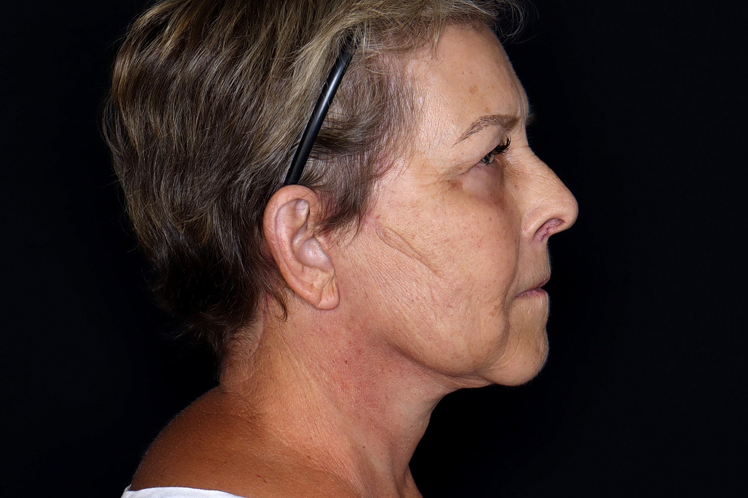 Blepharoplasty | Eyelid Lift Before & After