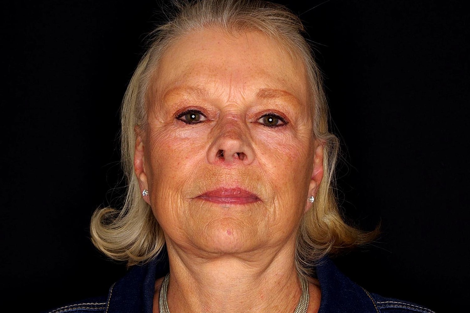 Brow Lift Before & After
