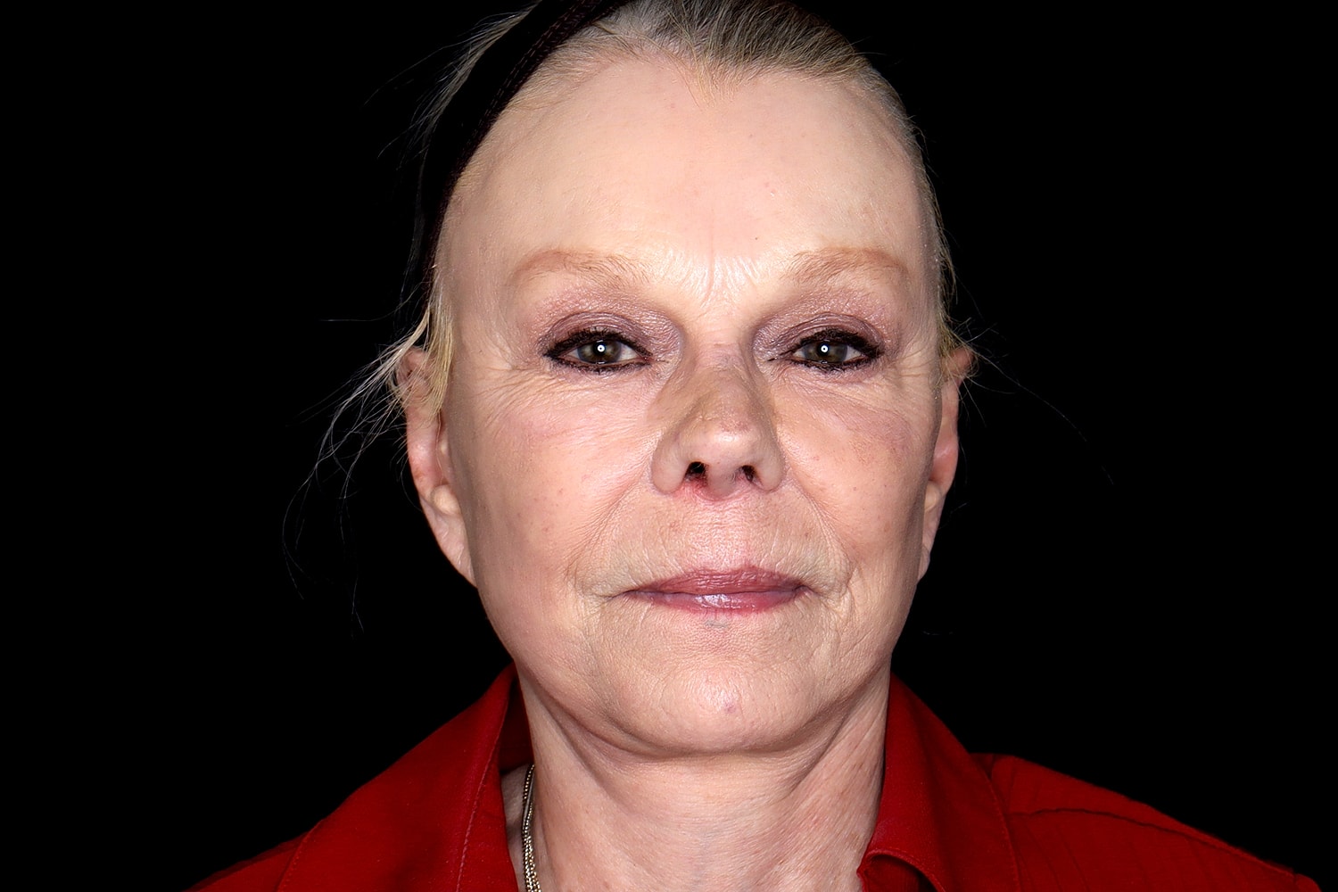 Brow Lift Before & After
