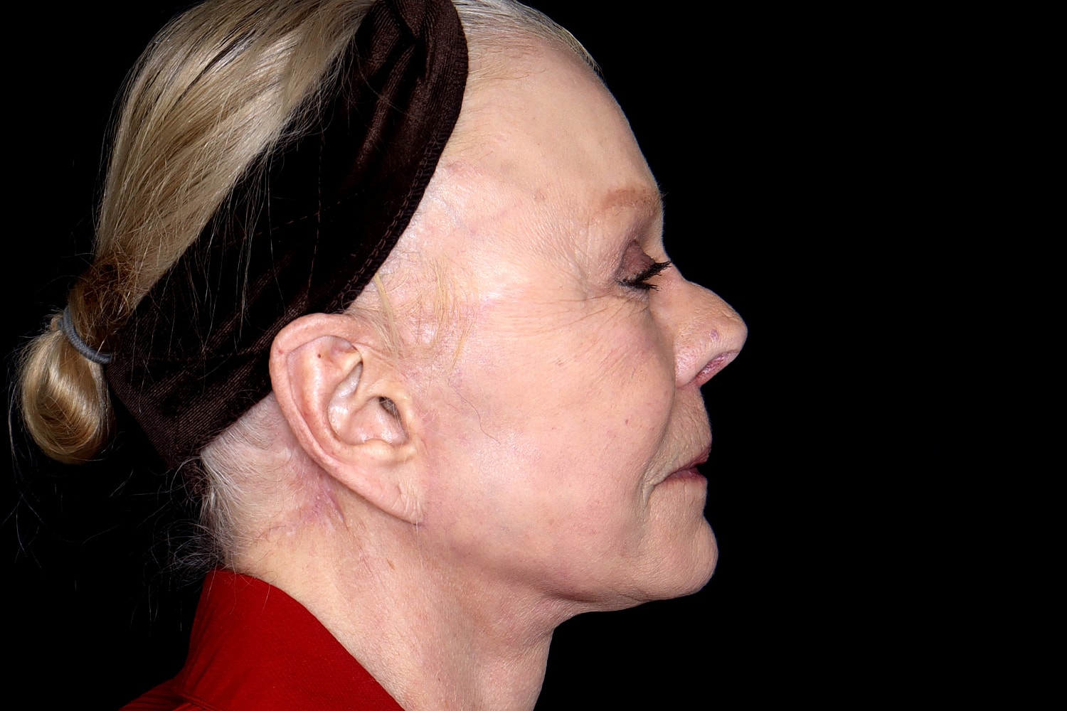 Brow Lift Before & After