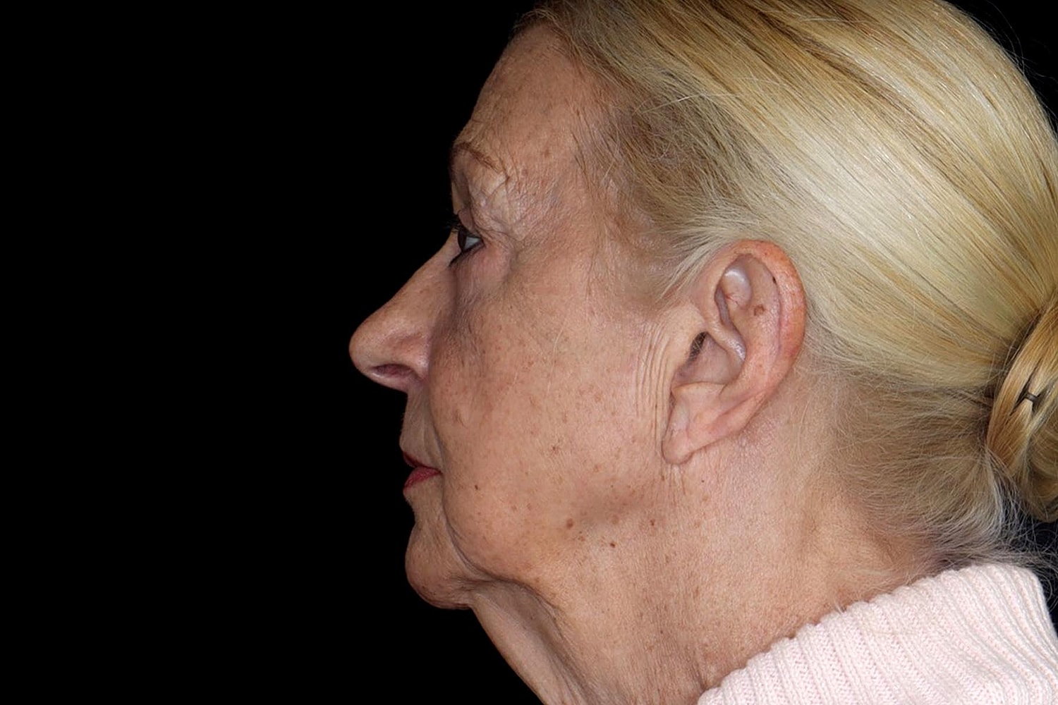 Brow Lift Before & After