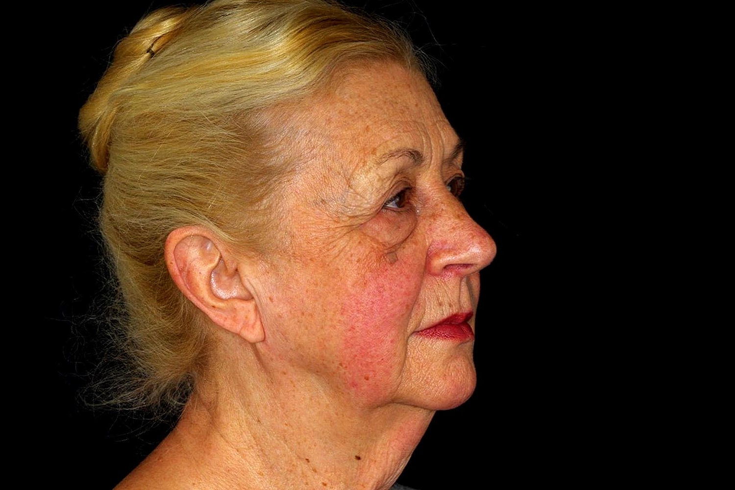 Brow Lift Before & After