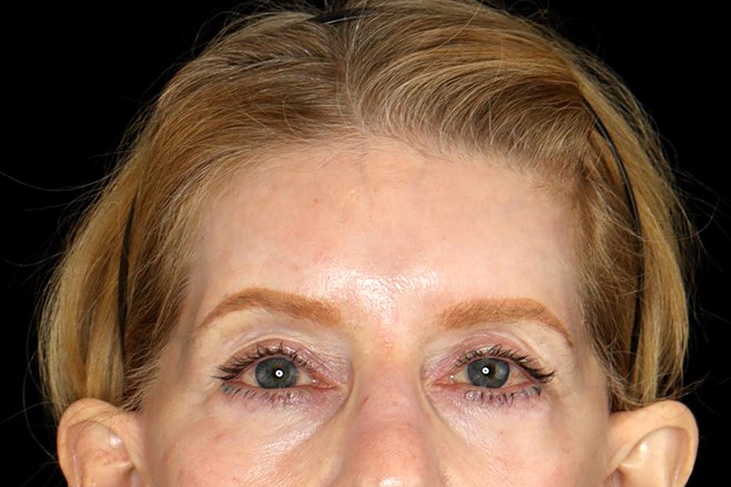 Brow Lift Before & After