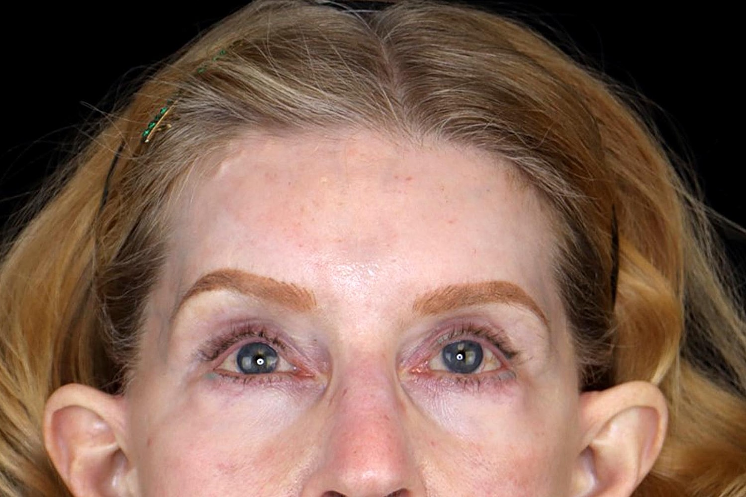 Brow Lift Before & After