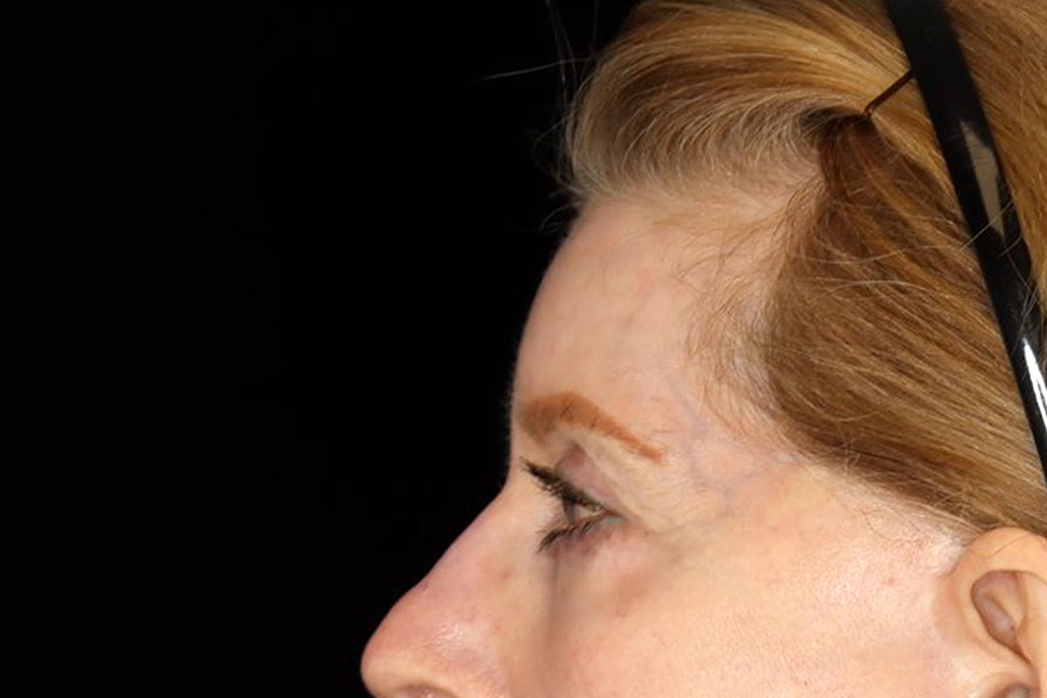 Brow Lift Before & After