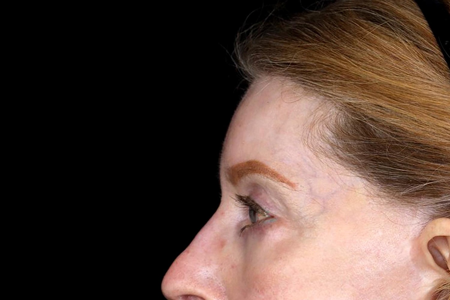 Brow Lift Before & After
