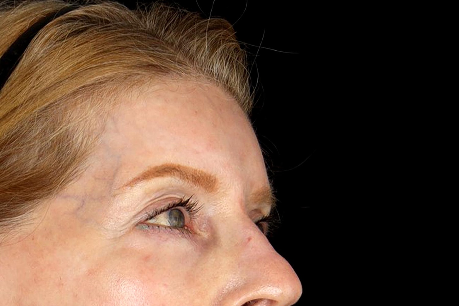 Brow Lift Before & After