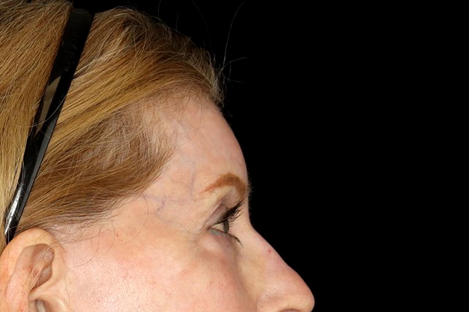Brow Lift Before & After