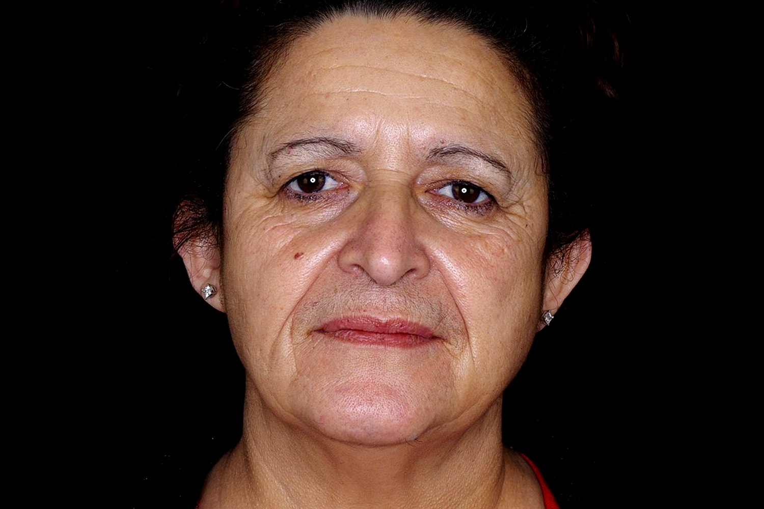 Brow Lift Before & After