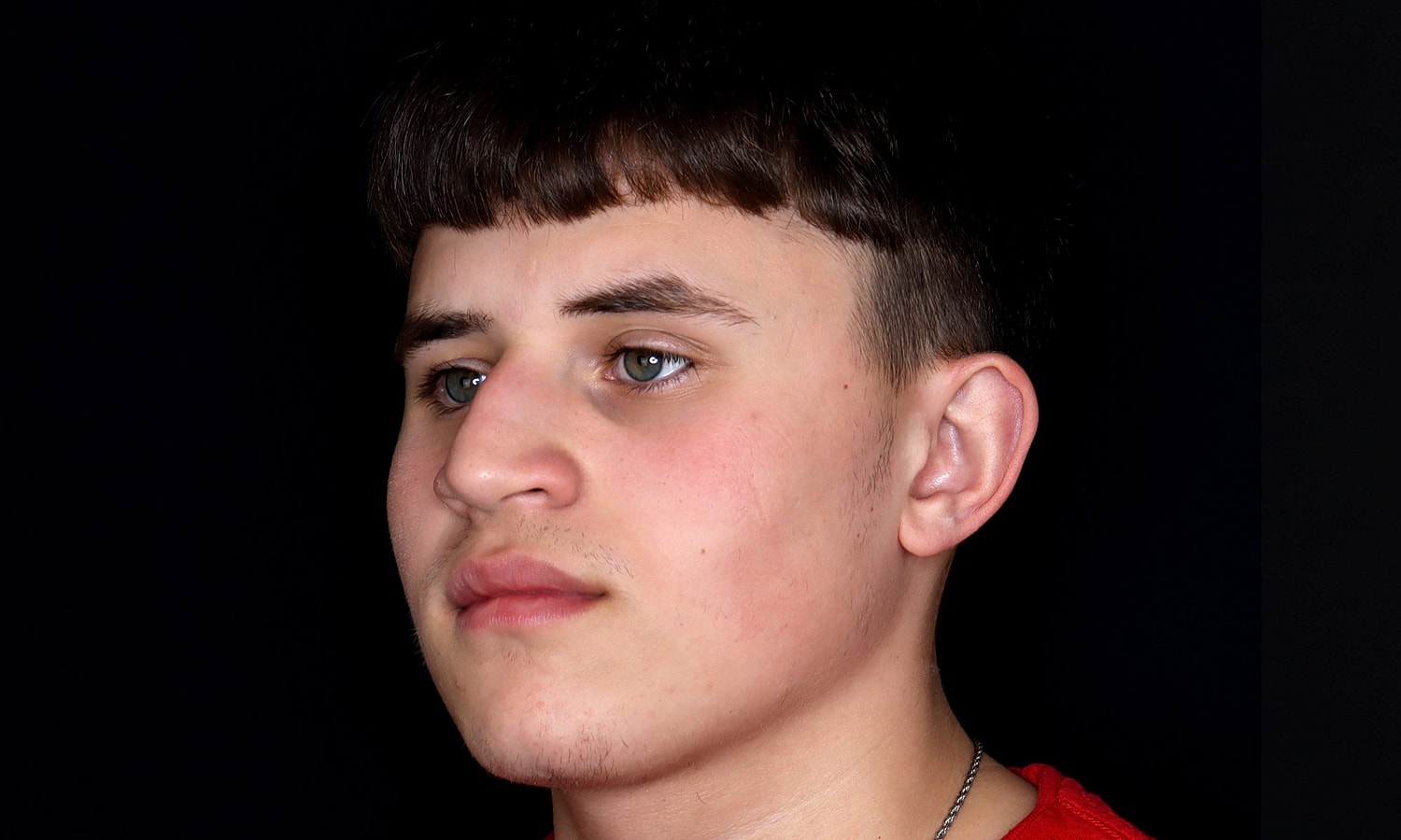 Rhinoplasty Before & After