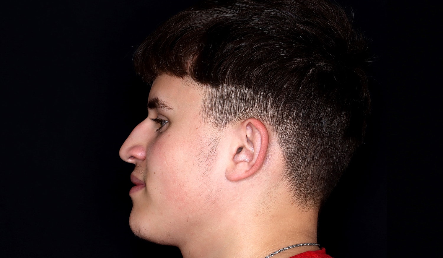 Rhinoplasty Before & After