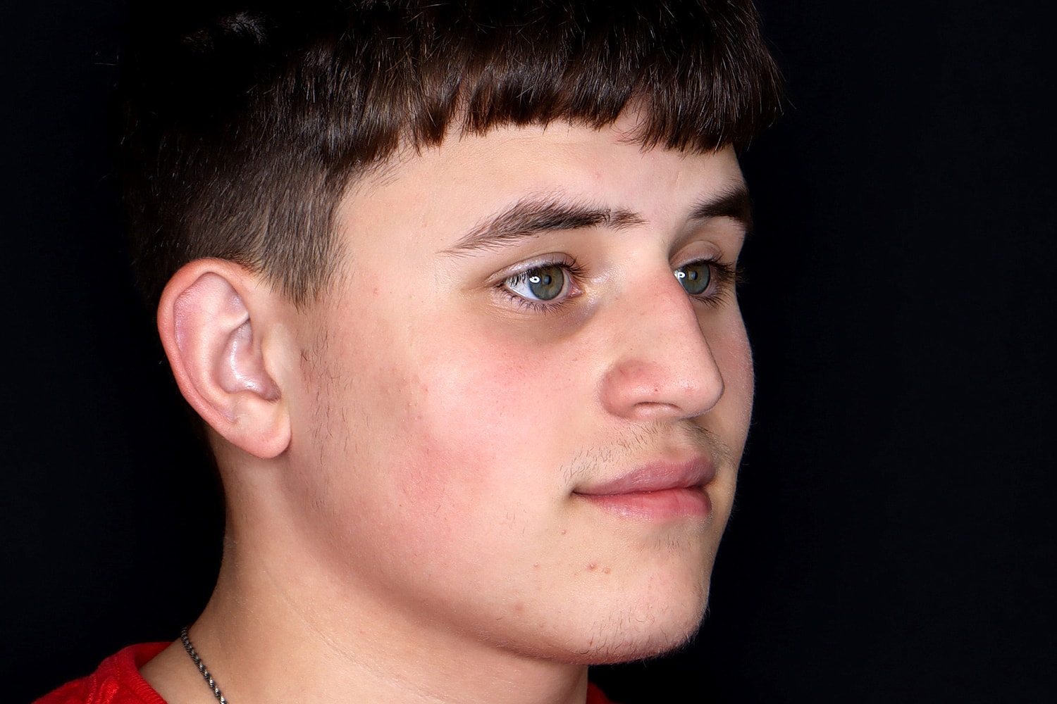 Rhinoplasty Before & After
