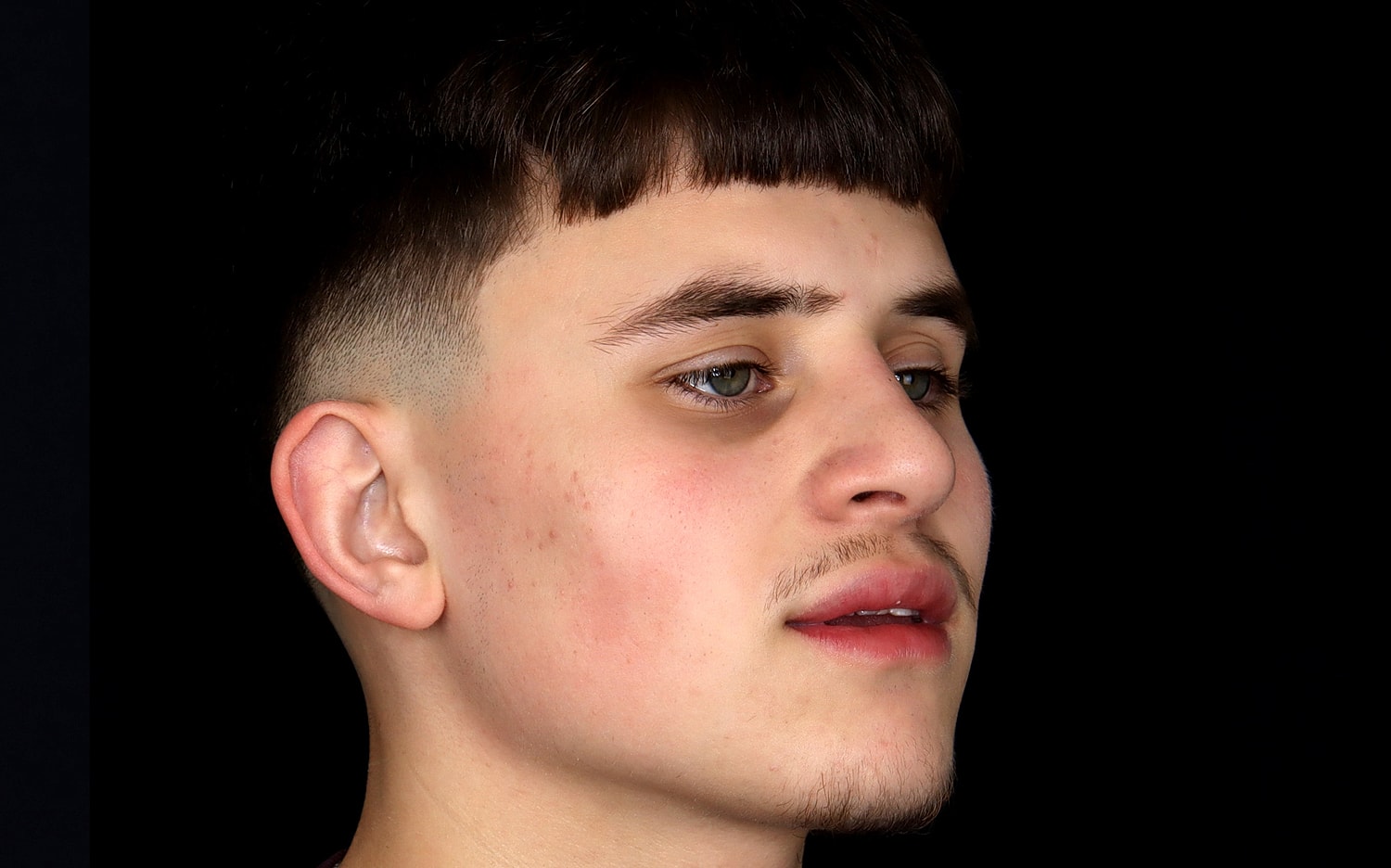 Rhinoplasty Before & After