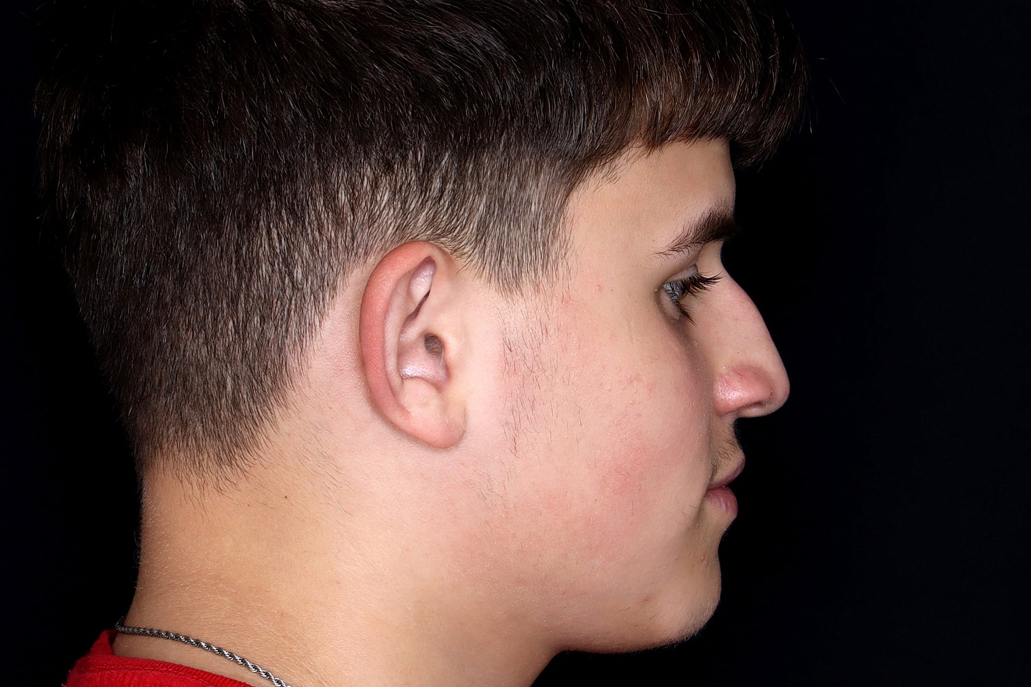 Rhinoplasty Before & After