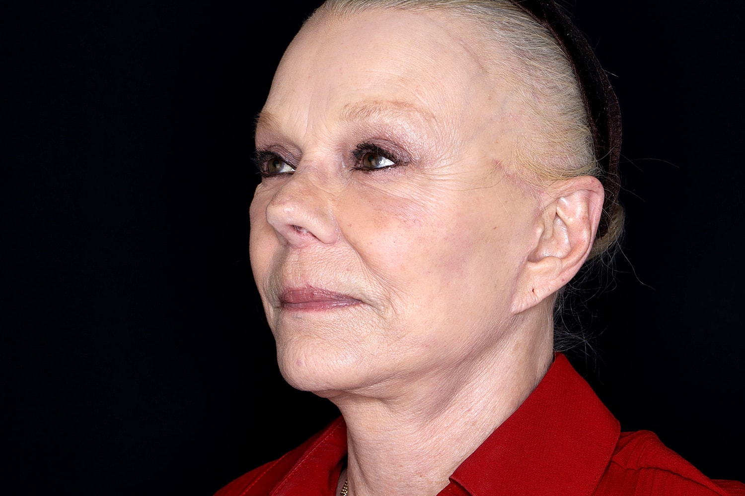 Facelift Before & After