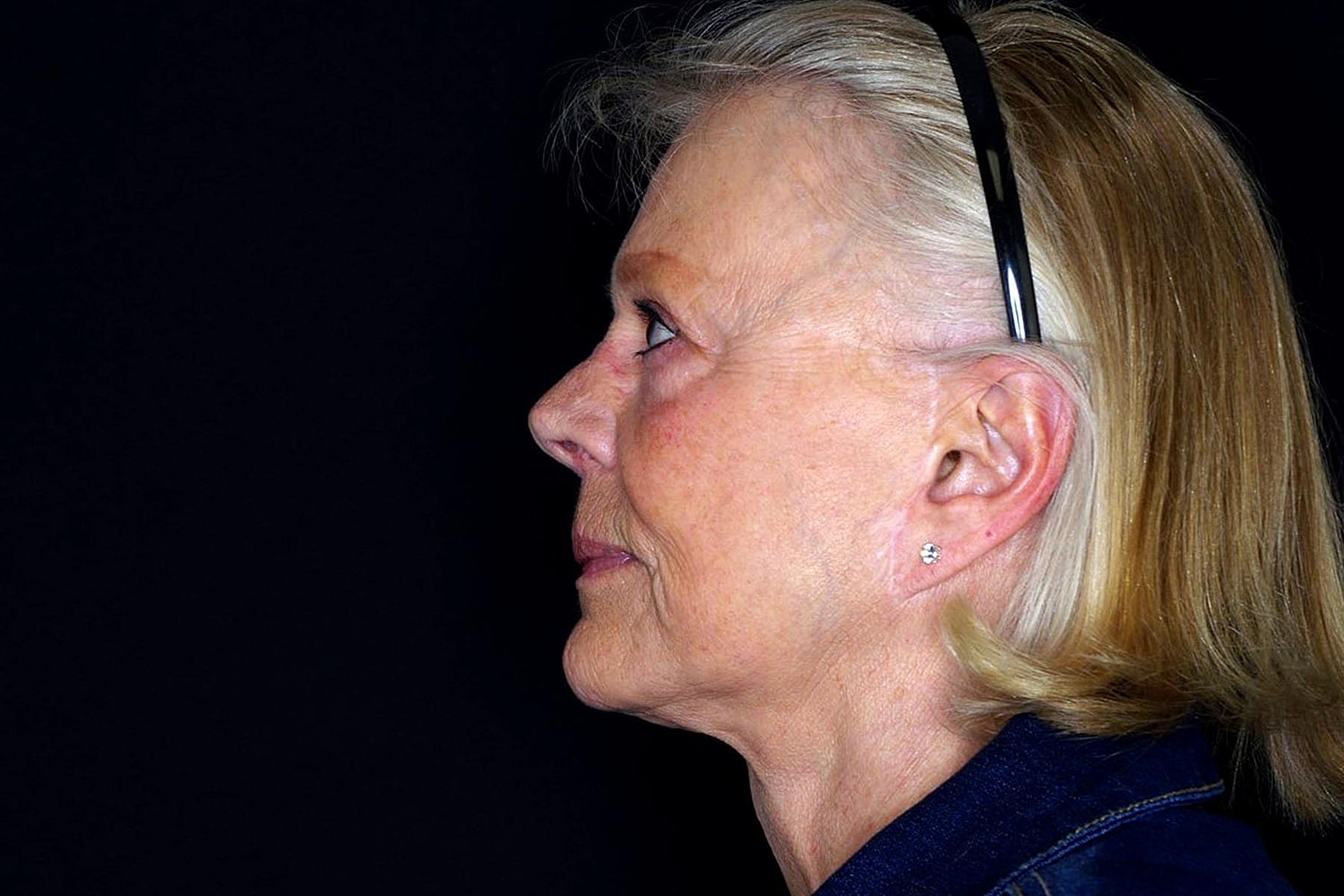Facelift Before & After