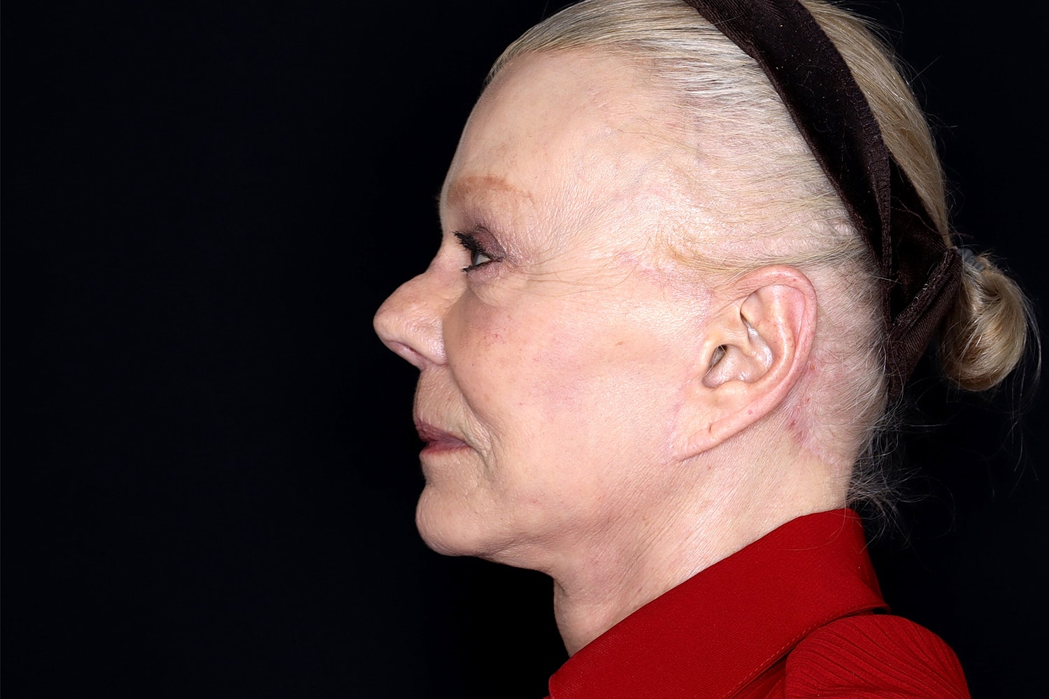 Facelift Before & After