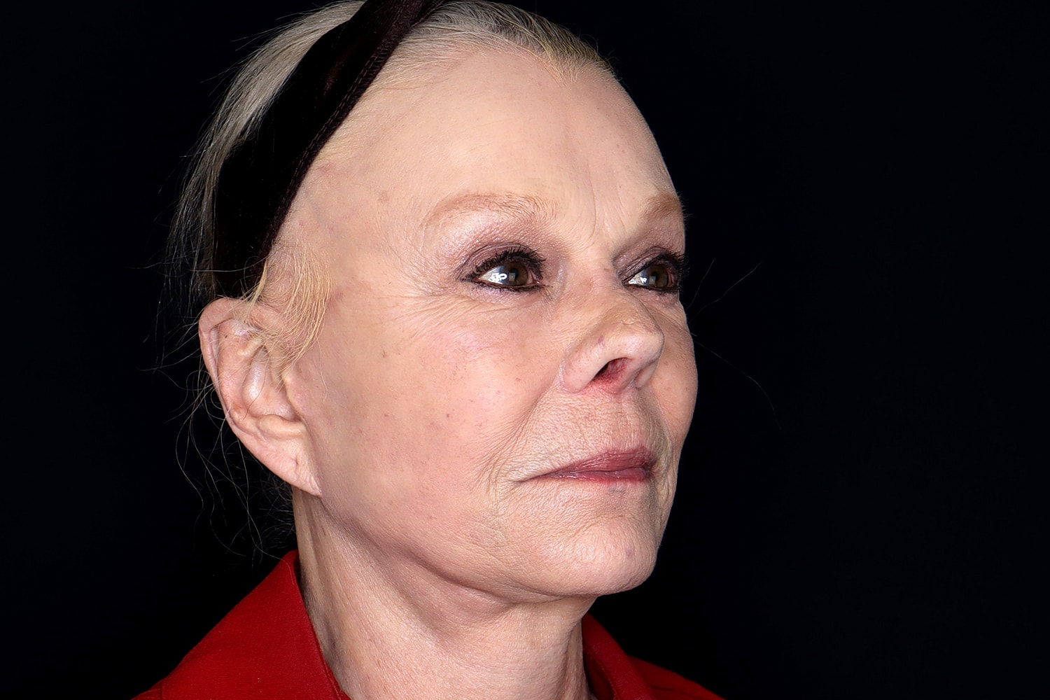 Facelift Before & After