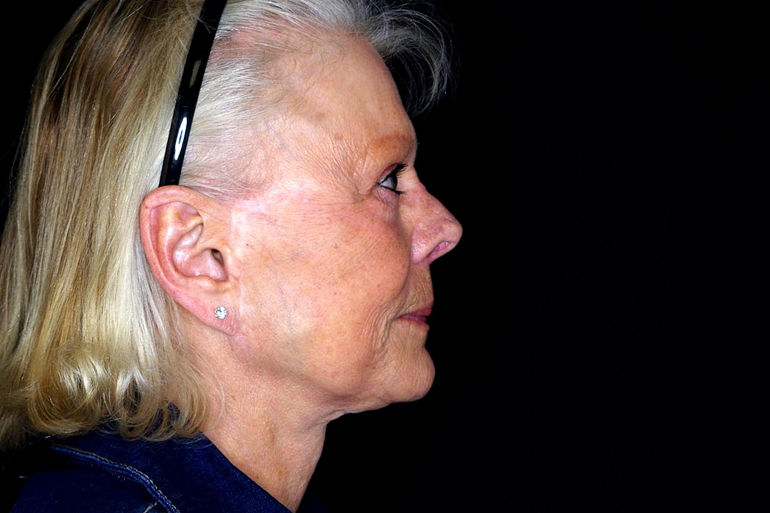 Facelift Before & After
