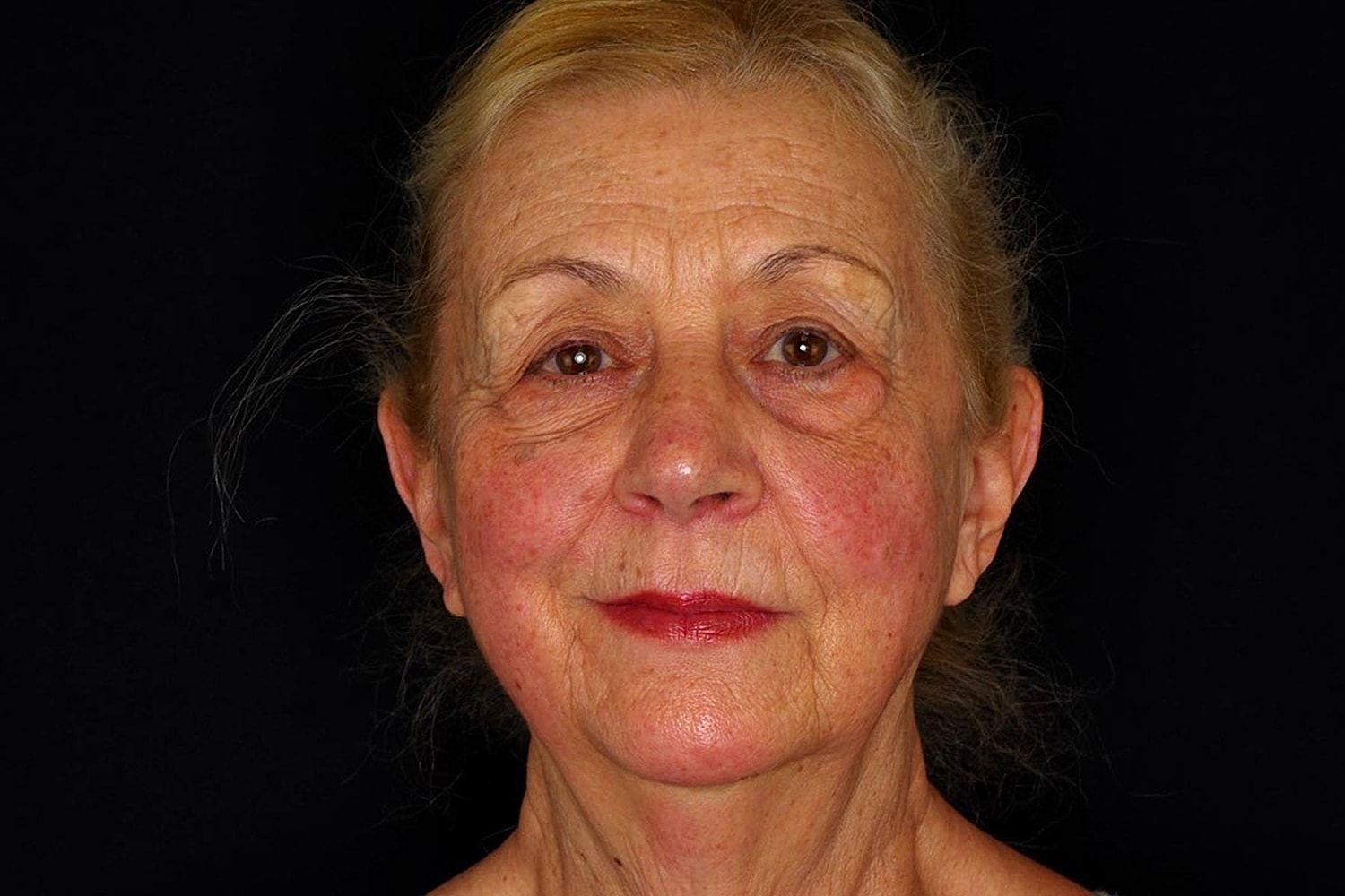 Facelift Before & After