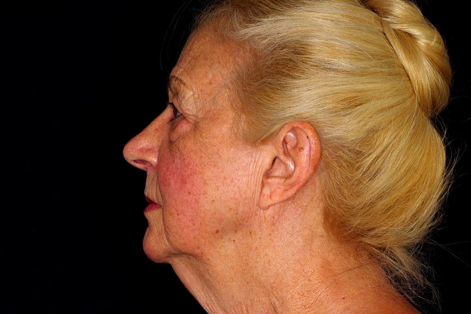 Facelift Before & After