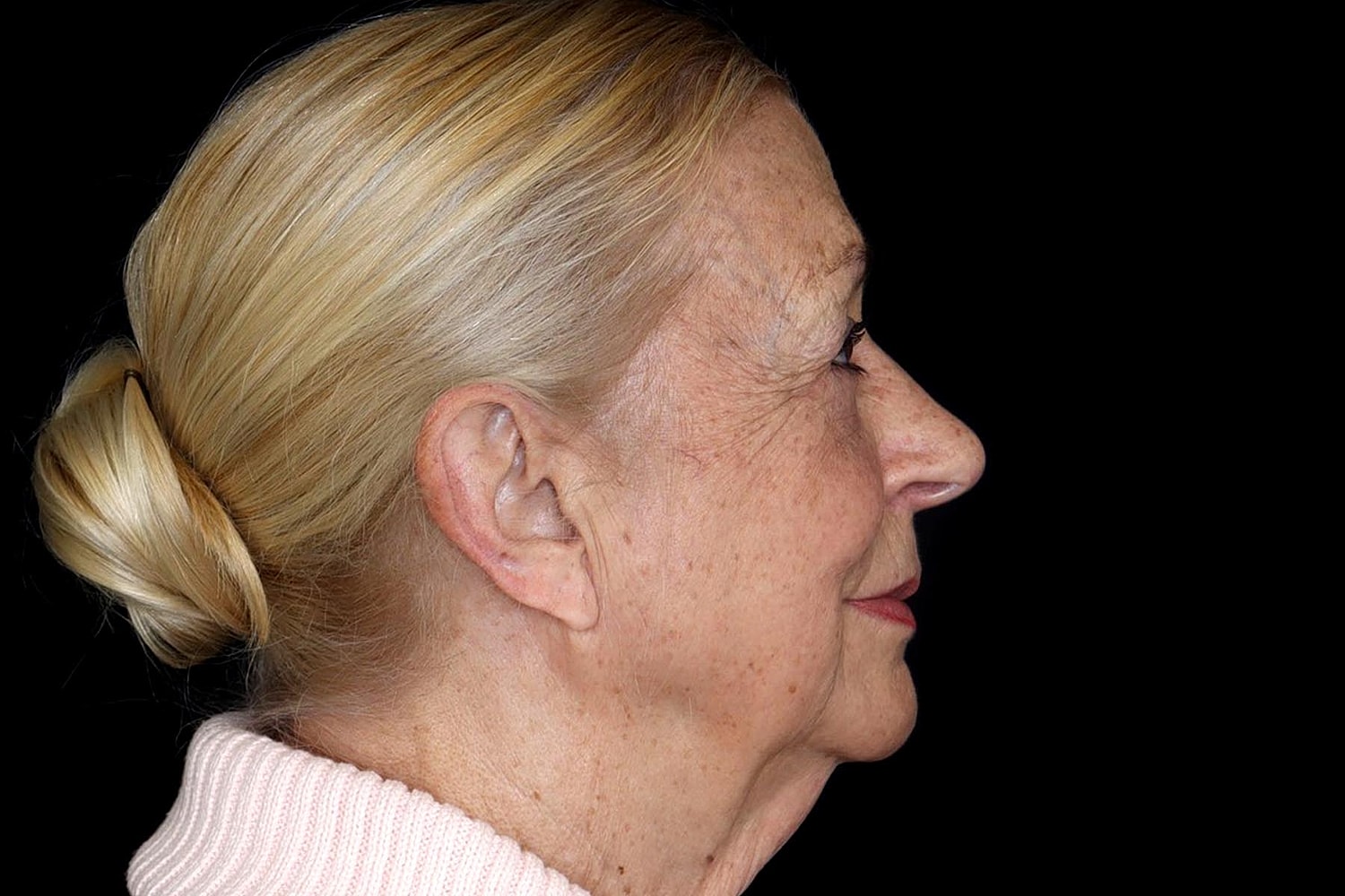 Facelift Before & After