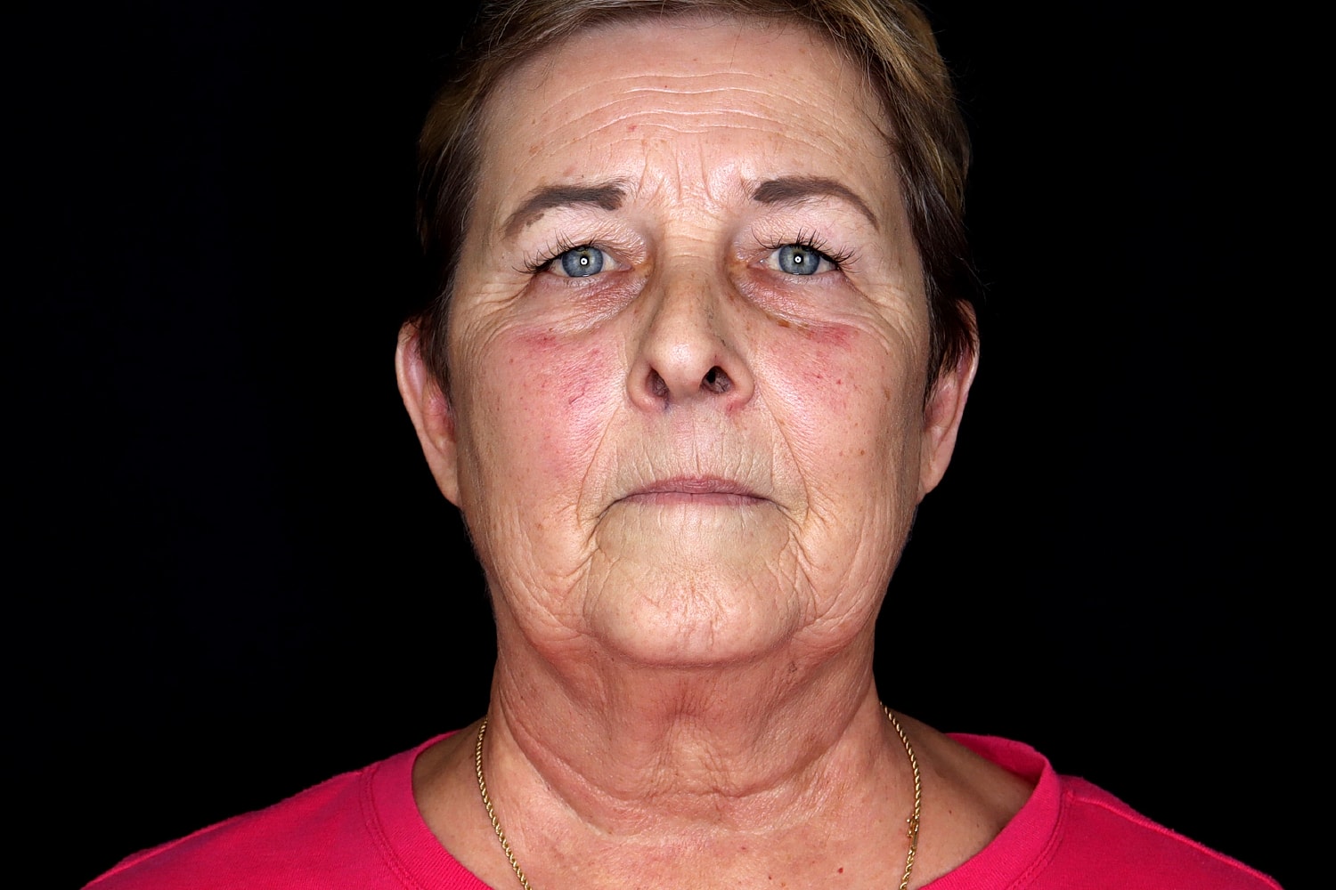 Facelift Before & After