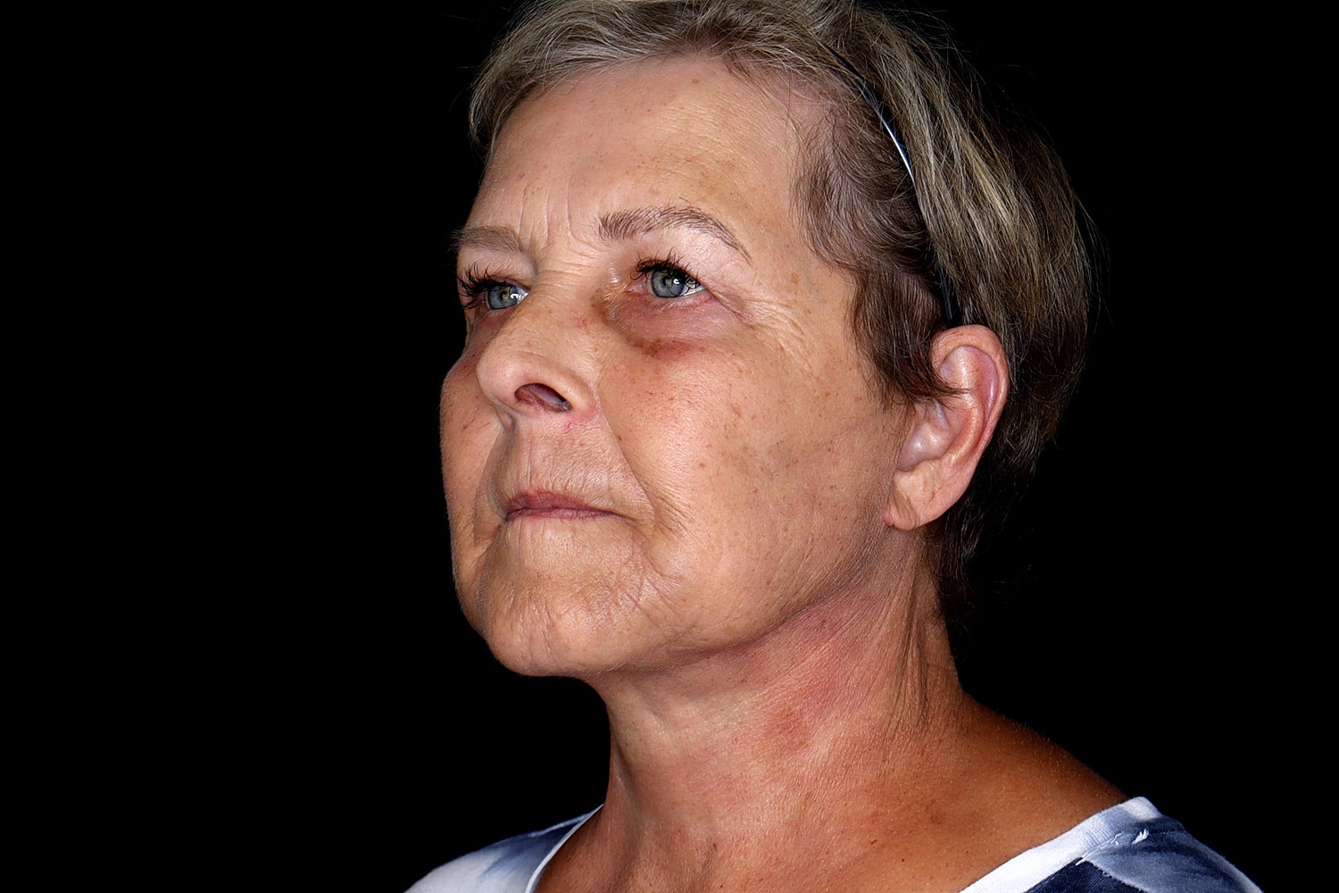 Facelift Before & After
