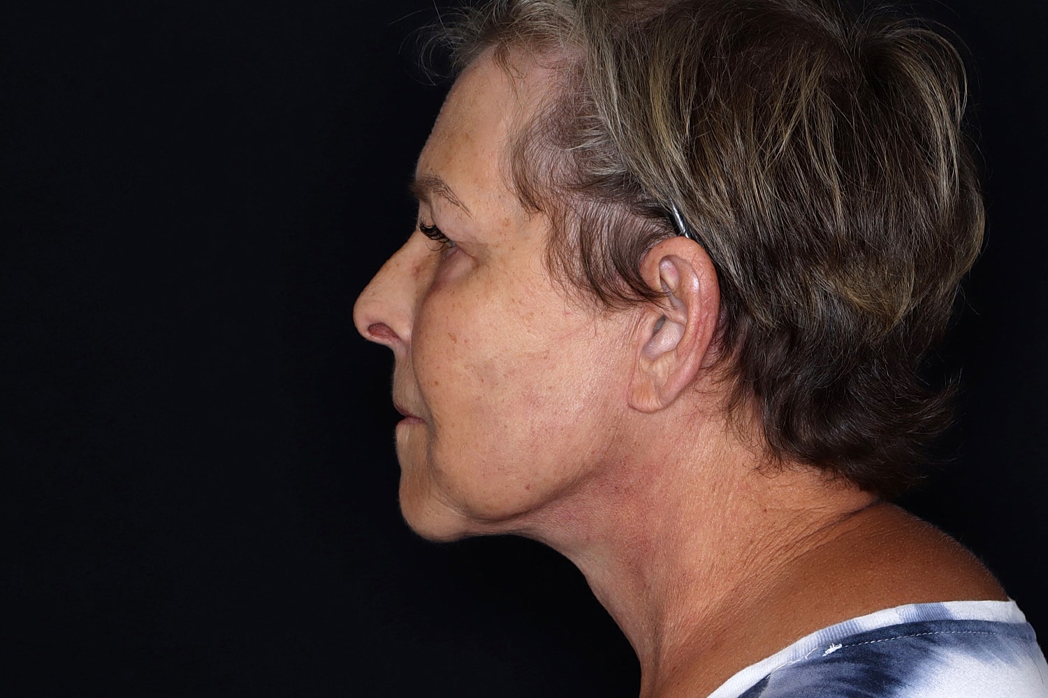 Facelift Before & After
