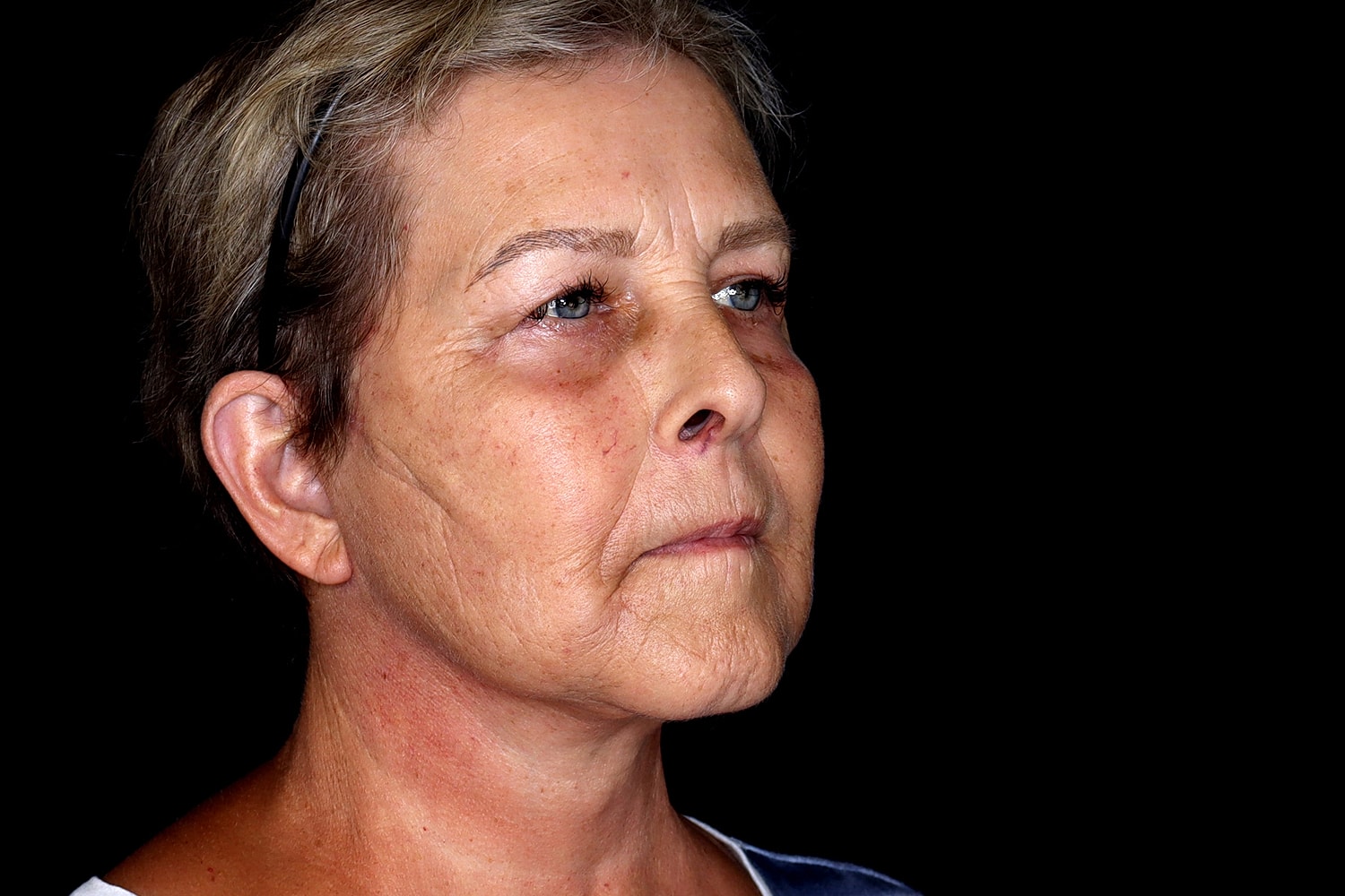 Facelift Before & After